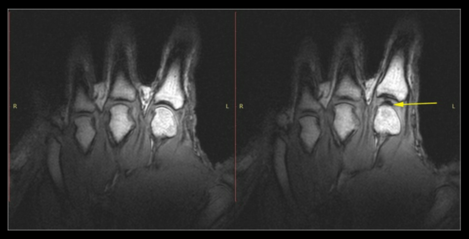 Слева: рука в покое перед растрескиванием. Справа: та же рука после хруста от растяжения. Обратите внимание на тёмную межсуставную полость (жёлтая стрелка). Источник изображения: pubmed.ncbi.nlm.nih.gov. Фото.