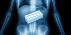 Что будет, если ребенок проглотит Lego: правда от врачей. Что будет, если ребенок проглотит Lego: правда от врачей. Фото.
