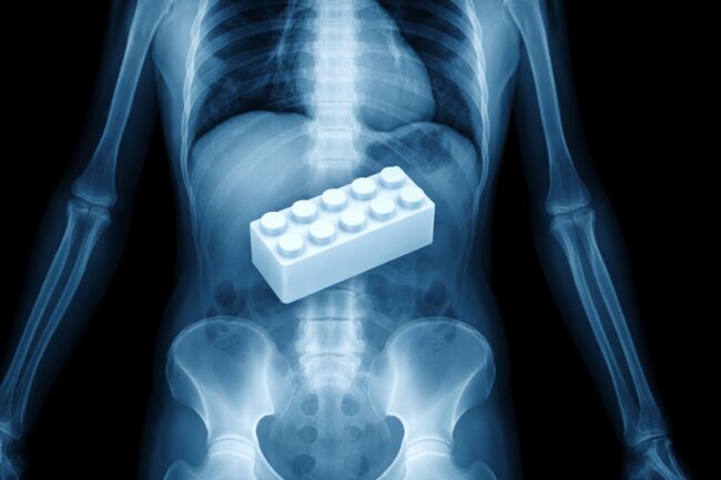 Что будет, если ребенок проглотит Lego: правда от врачей. Фото.