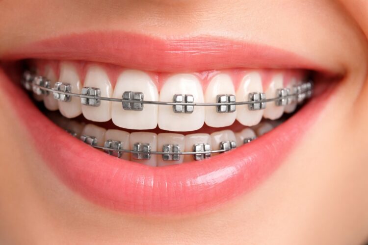 Как понять, что вы скрипите зубами во сне. У некоторых людей бруксизм появляется после установки брекетов или других ортодонтических конструкций. Фото.