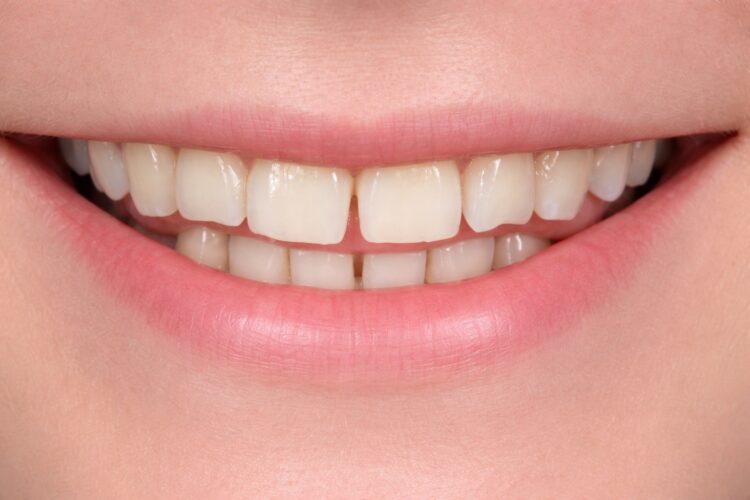 Чем опасен скрежет зубами. Из-за бруксизма у человека со временем стачиваются зубы. Фото.