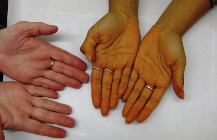 Почему нельзя есть много моркови. Руки при каротинемии. Источник изображения: afamily.vn. Фото.