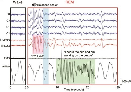 Зачем управлять снами. Пример решения головоломки в режиме реального времени. После того как участница показала, что ей снится осознанный сон, совершив серию движений глазами влево-вправо (выделено розовым), ей показали название одной из ее ранее нерешенных головоломок (продолжительность звукового сигнала выделена синим). Она быстро вдохнула и выдохнула (выделено зеленым), показывая, что услышала подсказку и работает над головоломкой. Источник изображения: academic.oup.com. Фото.