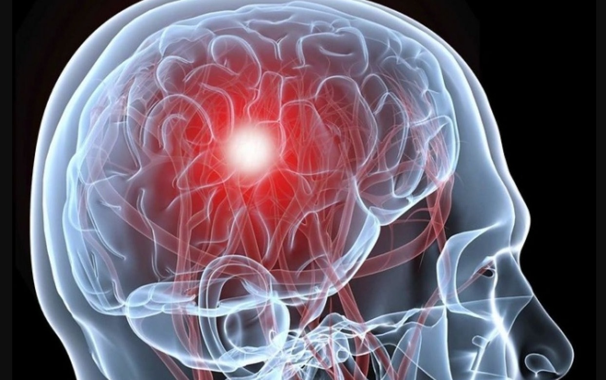 Мужчины и женщины подвержены такому виду инсульта примерно в равной степени, в отличие от инсультов другой природы. Источник изображения: obltv.ru. Фото.