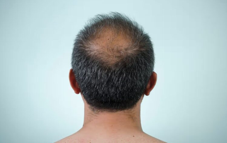 Облысение побеждено? Ученые впервые вырастили живые волосы. Три типа клеток, одна чашка Петри и немного терпения — так выглядит потенциальное будущее борьбы с облысением. Источник изображения: sciencealert.com. Фото.