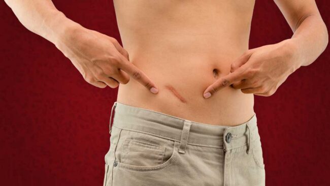 Зачем нужен аппендикс и почему его зря считали бесполезным. Фото.