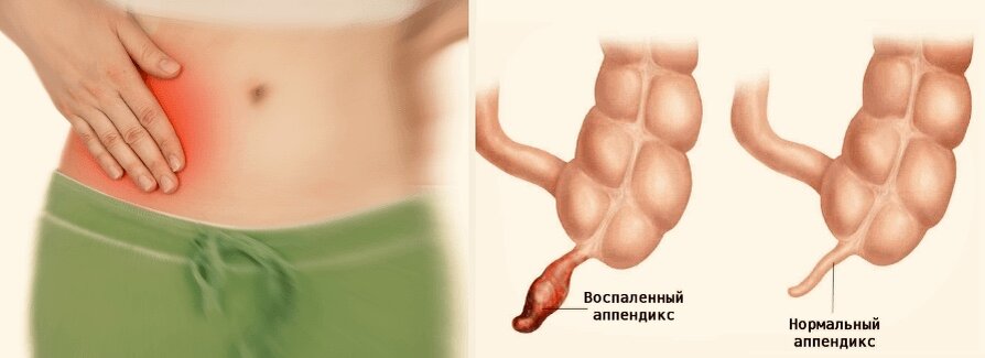 Можно ли жить без аппендикса и чем опасен аппендицит. Боль в правом нижнем углу живота — классический симптом аппендицита. Источник изображения: medicabil.com. Фото.
