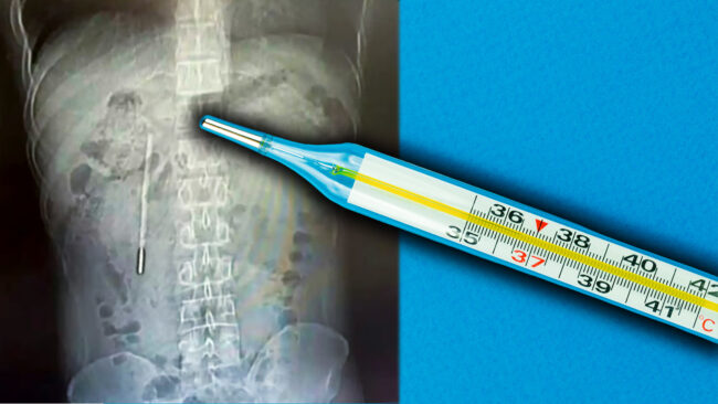 Китаец проглотил градусник в детстве и прожил с ним 20 лет. Китаец проглотил градусник в детстве и прожил с ним 20 лет. Фото.