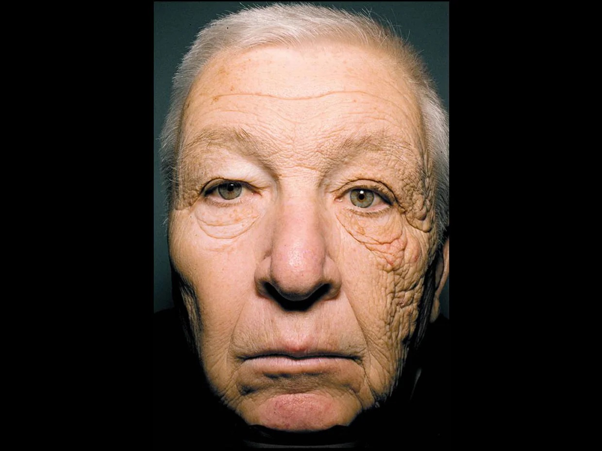 Тот самый 69-летний мужчина, который 28 лет водил грузовик. Одна сторона лица этого водителя выглядит поразительно старше другой. Фото.
