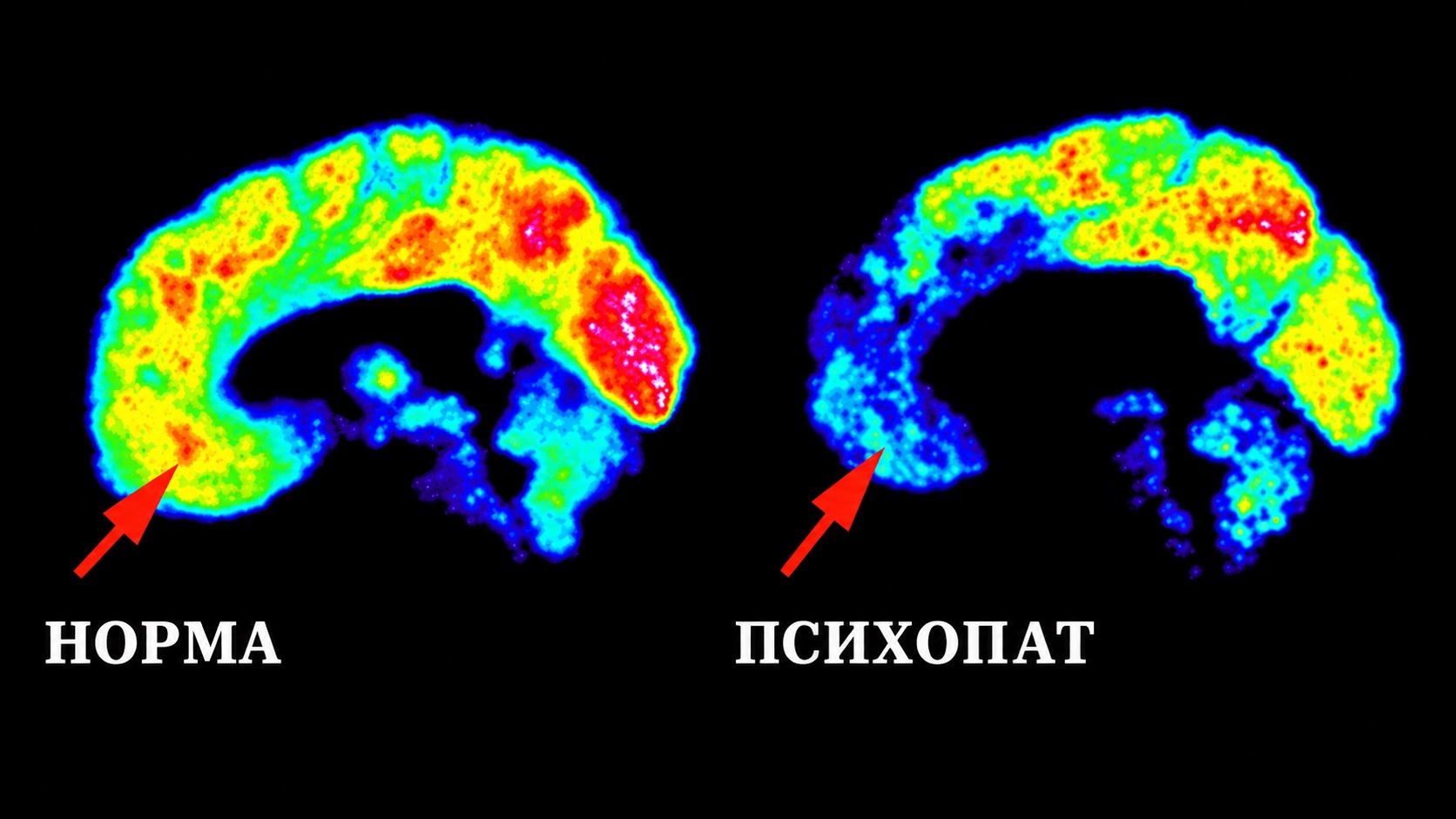 Скан мозга обычного человека и психопата